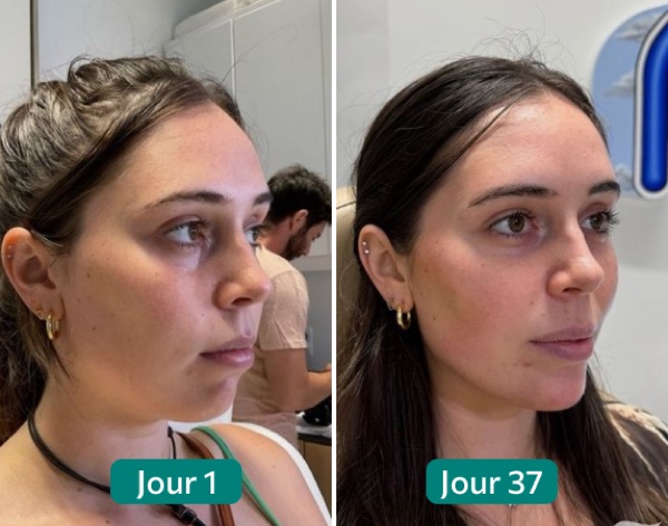 Nuclever Ergebnis Sophie — Vorher Tag 1 / Nachher Tag 37