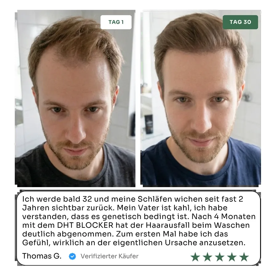 Nuclever DHT Blocker Vorher Nachher Mann — dichtere Haarlinie nach 4 Monaten