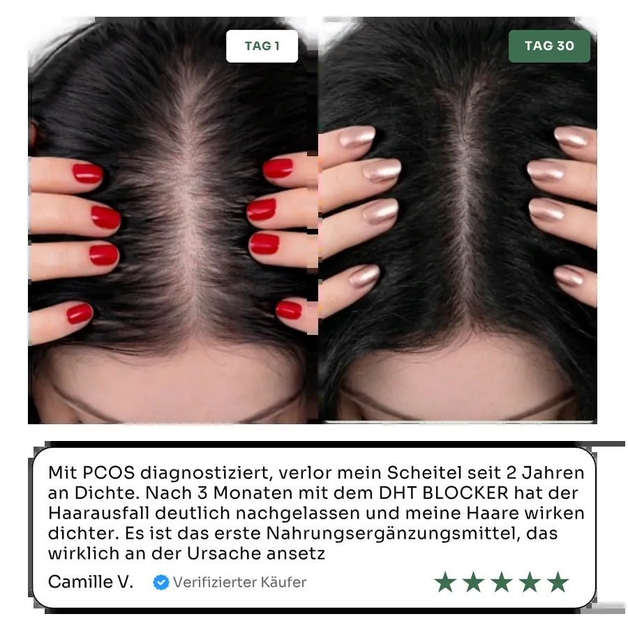 Nuclever DHT Blocker Vorher Nachher Frau — Haardichte Tag 1 vs. Tag 30